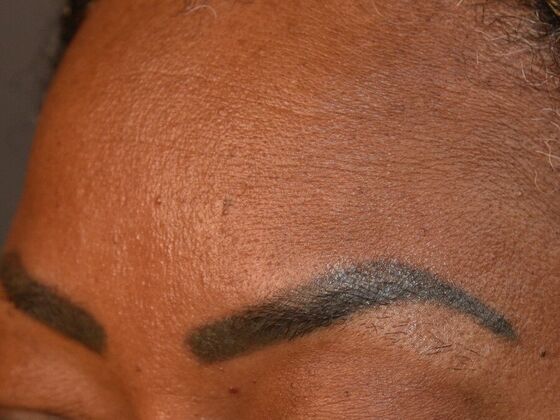 Eyebrow Transplantation: Case 1 - Before