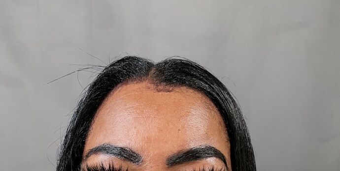 Eyebrow Transplantation: Case 1 - After