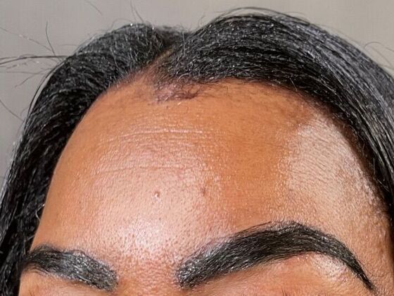 Eyebrow Transplantation: Case 1 - After