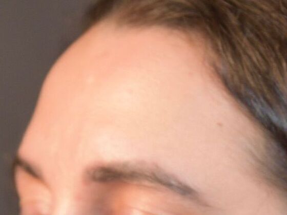 Eyebrow Transplantation: Case 2 - Before