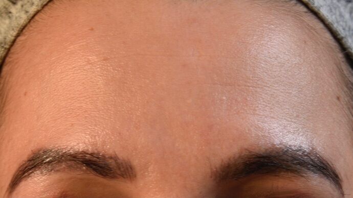 Eyebrow Transplantation: Case 2 - After