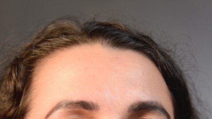 Eyebrow Transplantation: Case 2 - Before