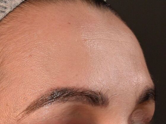 Eyebrow Transplantation: Case 2 - After