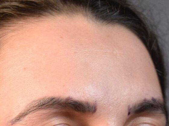 Eyebrow Transplantation: Case 2 - Before