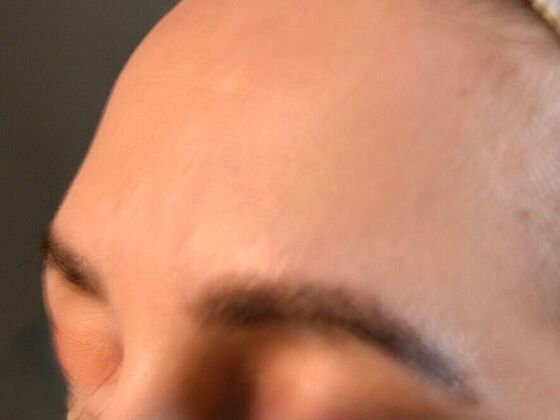 Eyebrow Transplantation: Case 2 - After