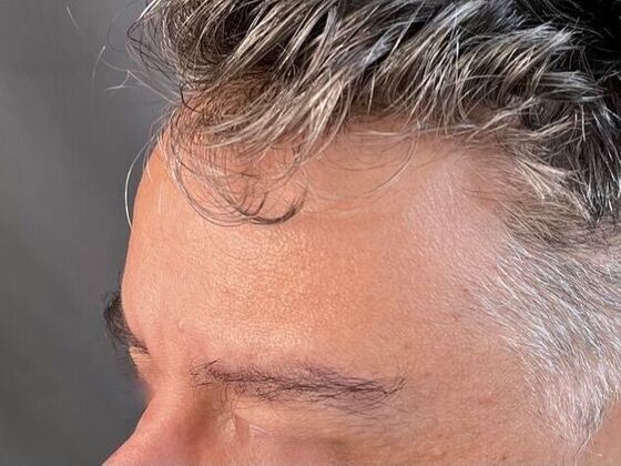 Eyebrow Transplantation: Case 3 - After