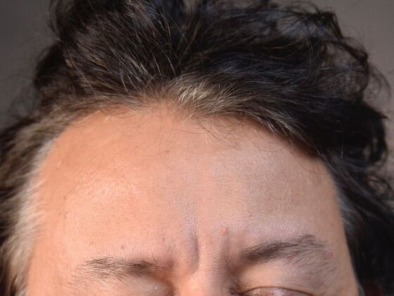 Eyebrow Transplantation: Case 3 - After