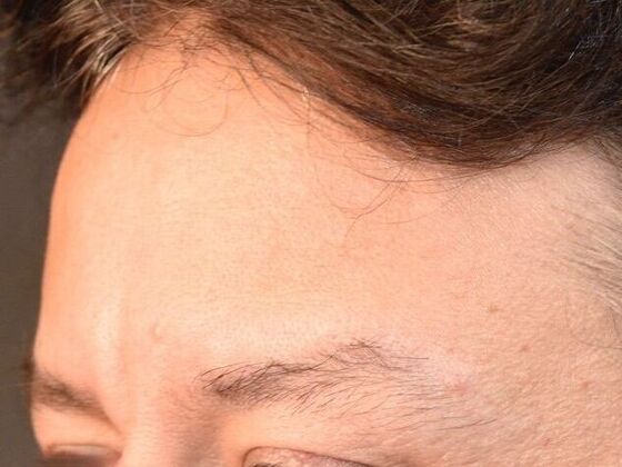Eyebrow Transplantation: Case 3 - Before