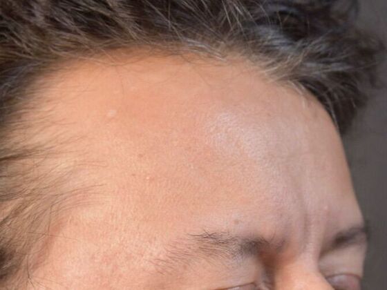 Eyebrow Transplantation: Case 3 - Before