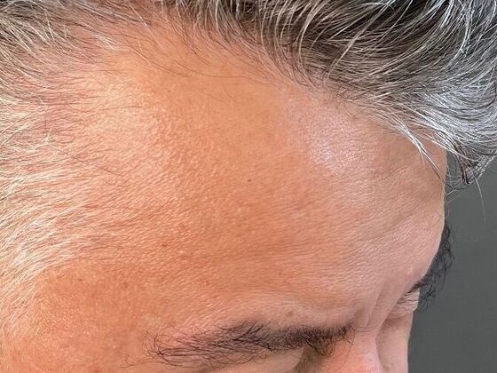 Eyebrow Transplantation: Case 3 - After