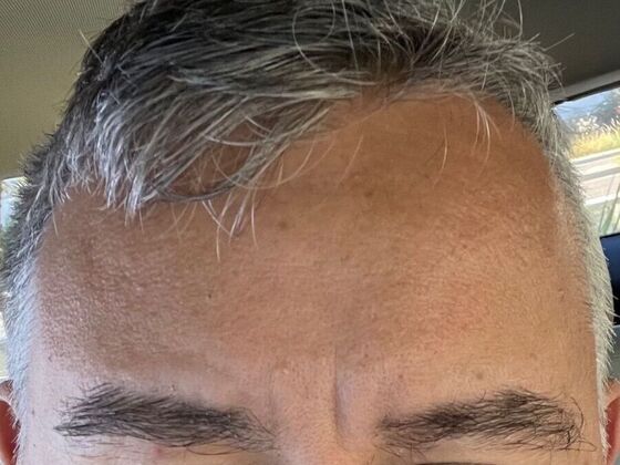 Eyebrow Transplantation: Case 3 - Before