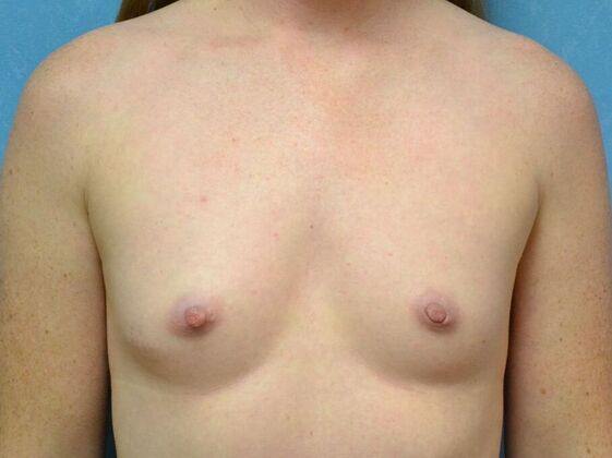 Breast Augmentation Case 1770- Perrysburg, OH - Before