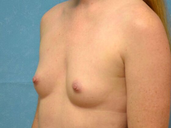 Breast Augmentation: Case 1770- Perrysburg, OH - Before