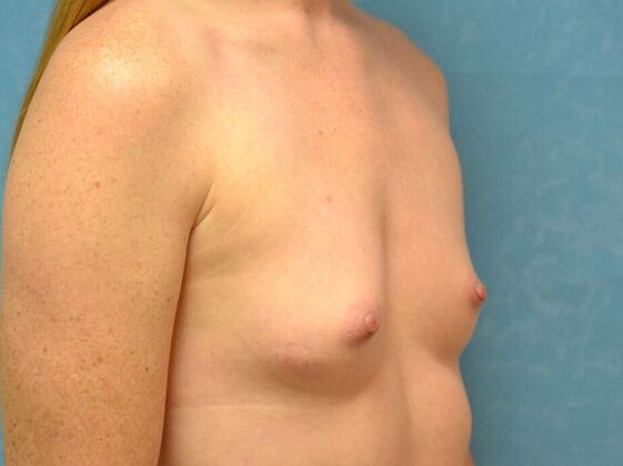 Breast Augmentation: Case 1770- Perrysburg, OH - Before