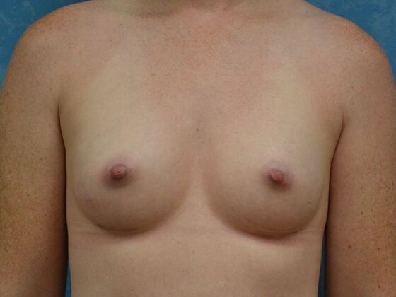 Breast Augmentation Case 1770- Perrysburg, OH - After