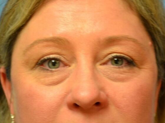 Eye Lift (Blepharoplasty) Case 1781- Riga, MI - Before
