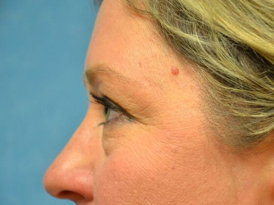 Eye Lift (Blepharoplasty): Case 1781- Riga, MI - Before