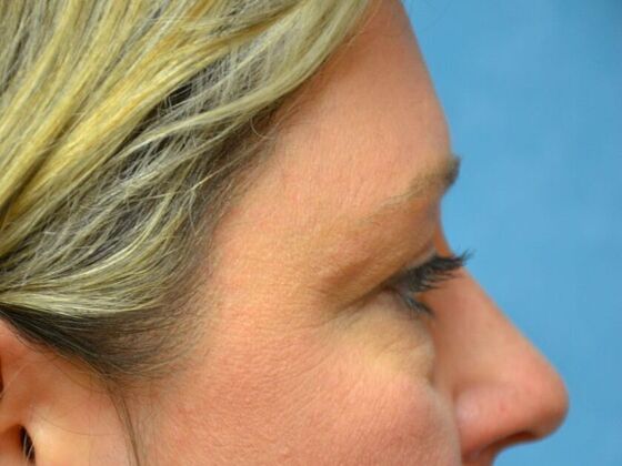 Eye Lift (Blepharoplasty): Case 1781- Riga, MI - Before