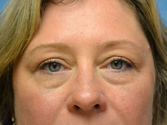 Eye Lift (Blepharoplasty) Case 1781- Riga, MI - After