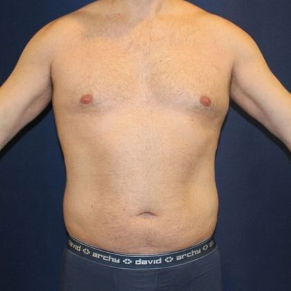 Liposuction Case 5 - Before