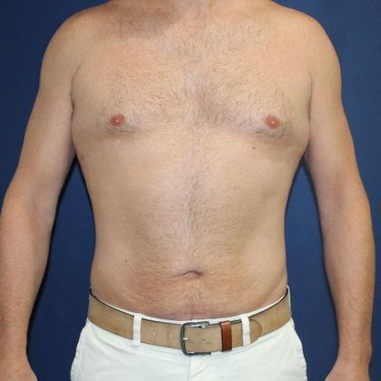 Liposuction Case 5 - After