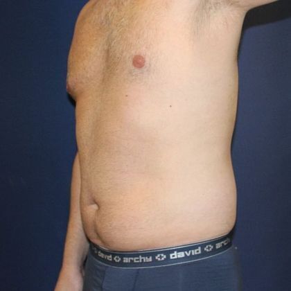 Liposuction: Case 5 - Before