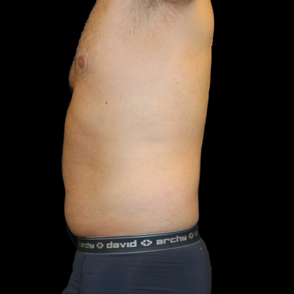 Liposuction: Case 5 - Before