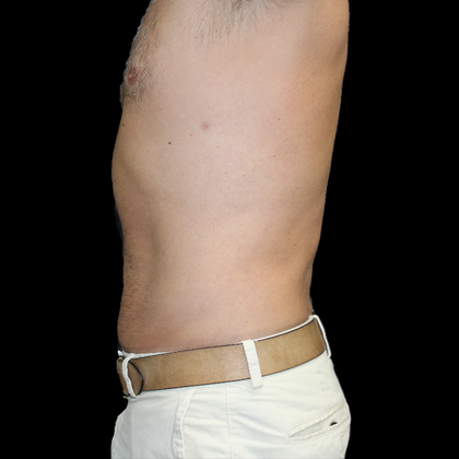 Liposuction: Case 5 - After