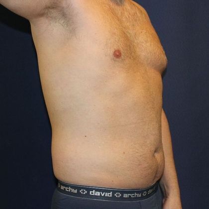 Liposuction: Case 5 - Before