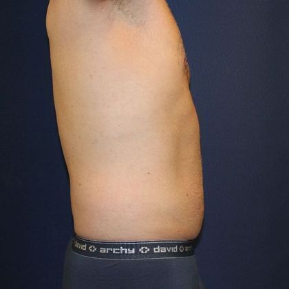 Liposuction: Case 5 - Before