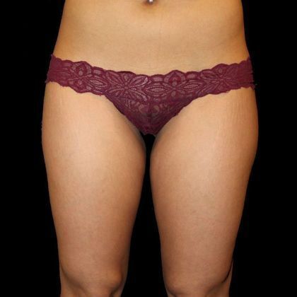 Liposuction Case 6 - Before