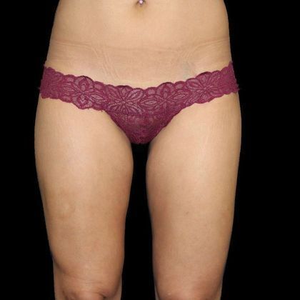 Liposuction Case 6 - After