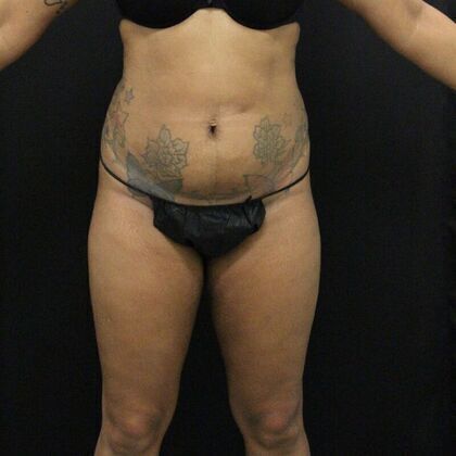 Liposuction Case 8 - Before