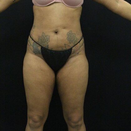 Liposuction Case 8 - After