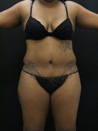 Liposuction Case 9 - Before