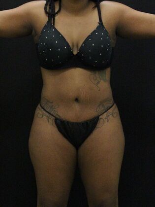 Liposuction Case 9 - After