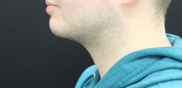 Liposuction: Case 10 - After