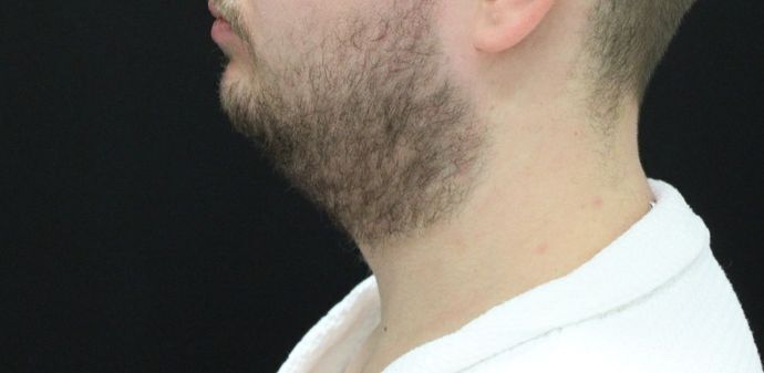 Liposuction: Case 10 - Before