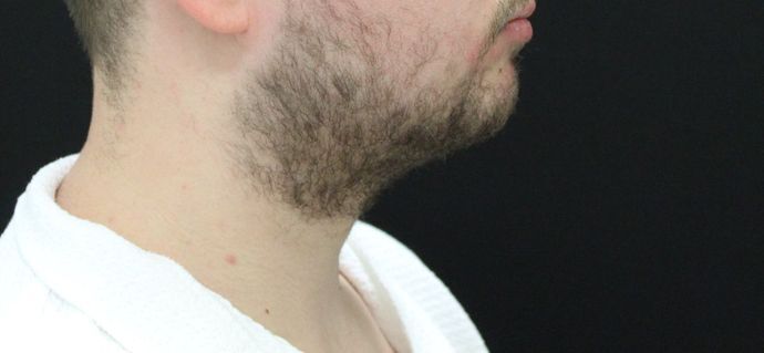 Liposuction: Case 10 - Before