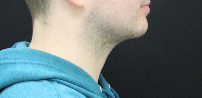 Liposuction: Case 10 - After