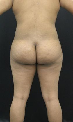 Liposuction: Case 11 - After