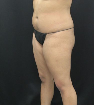 Liposuction: Case 11 - Before