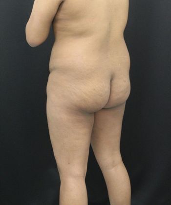 Liposuction: Case 11 - Before