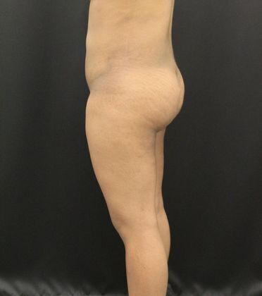 Liposuction: Case 11 - After