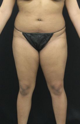 Liposuction: Case 11 - Before