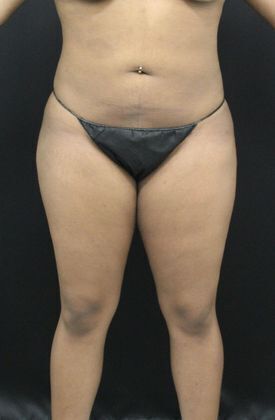 Liposuction: Case 11 - After