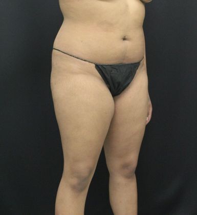 Liposuction: Case 11 - Before