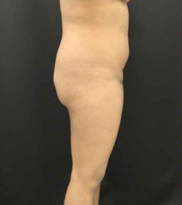 Liposuction: Case 11 - Before