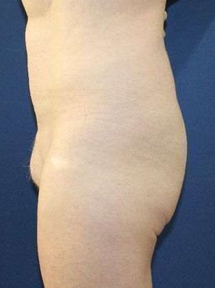 Liposuction Case 12 - Before