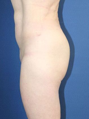 Liposuction Case 12 - After